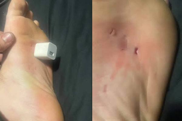 Shocking Foot Injury Goes Viral – You Won’t Believe What Happened